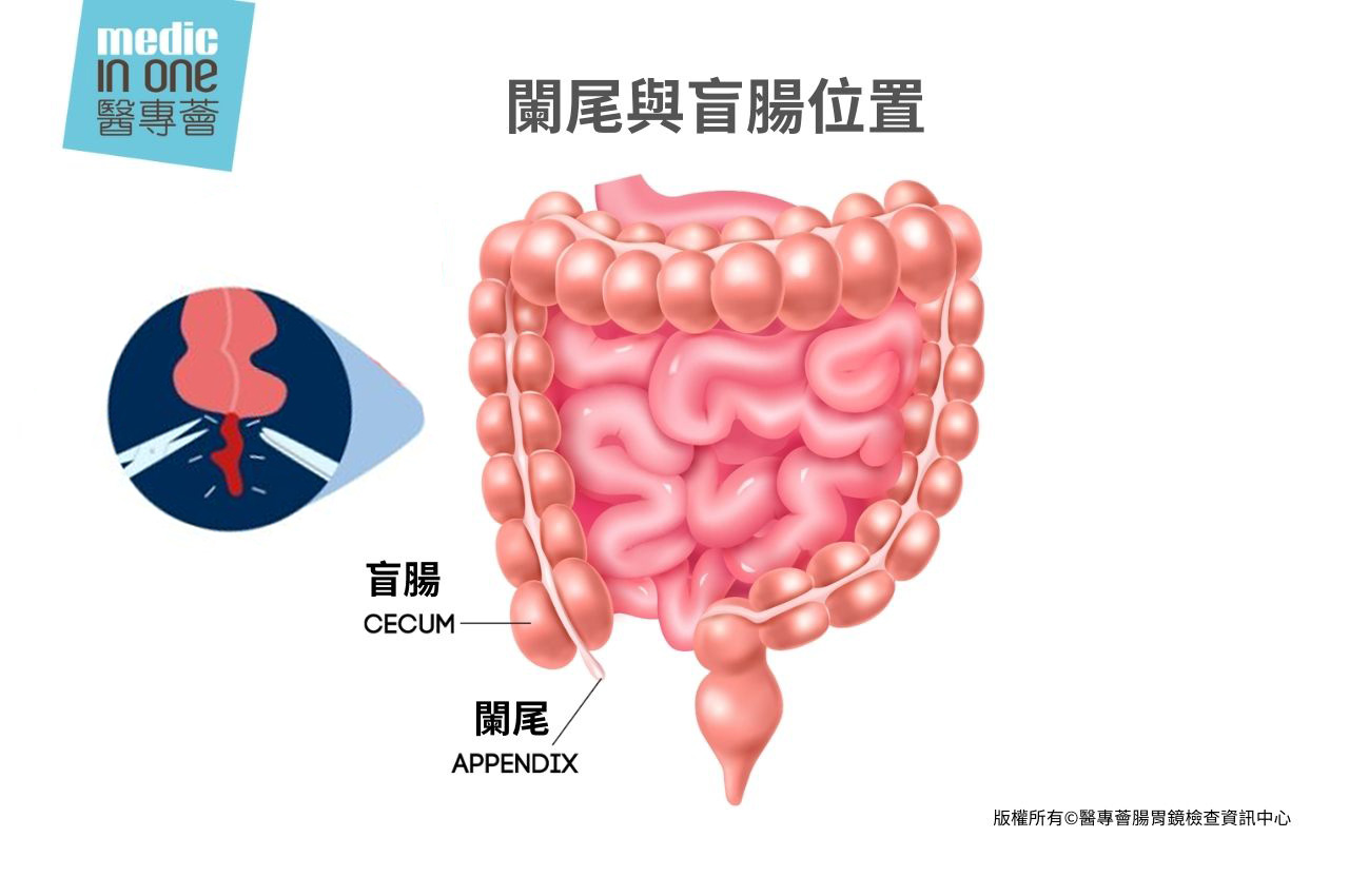 闌尾跟盲腸不同！盲腸炎病徵原來跟闌尾癌有關？